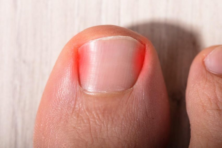 ingrown-toenail-podiatry-on-plenty